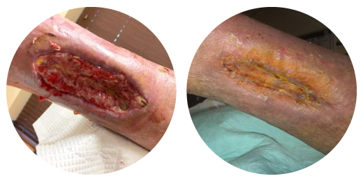 diabetic leg wound