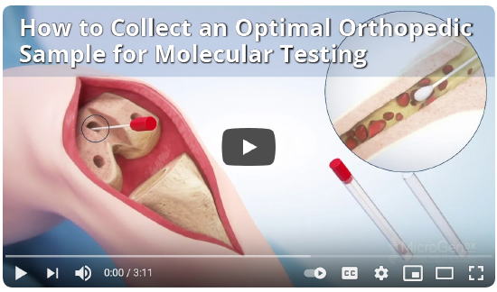 How to Collect OrthoKey Surgery