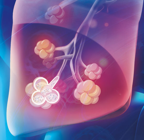 Pulmonary Infection qPCR vs NGS