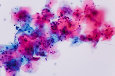 NGS Fills Current Gaps in Antifungal Susceptibility Testing