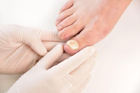 superior diagnosis for nail infections